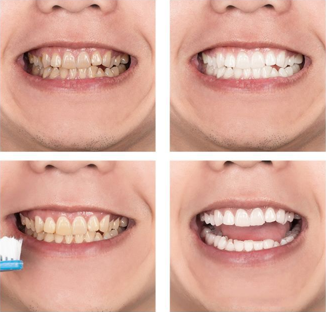 Mousse Teeth Cleaning Foam - LANBENA Whitening